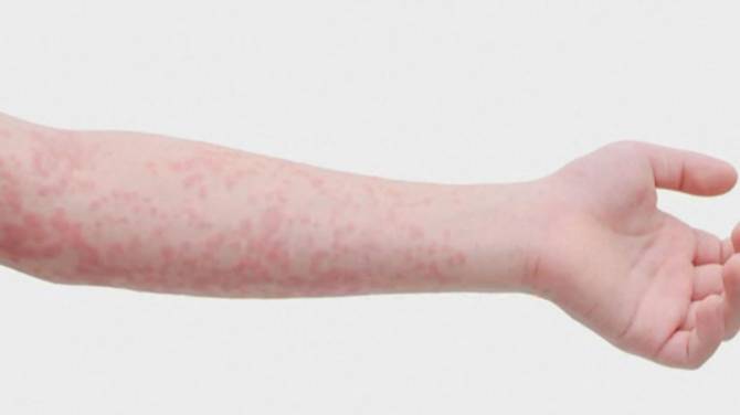 Click to play video: Measles: the symptoms to watch for, and what vaccinated people need to know