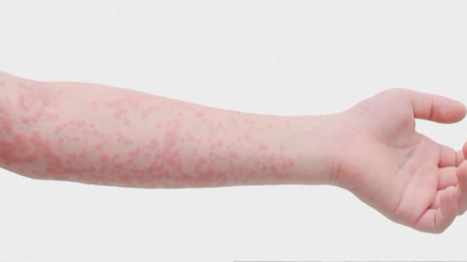 Click to play video: Spring travel could bring measles outbreak, Canada’s top doctor says