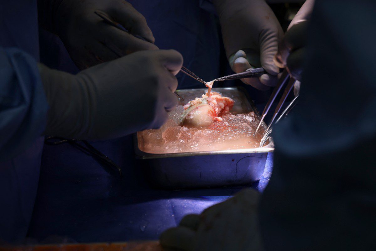 (FILES) In this March 16, 2024, image courtesy of the Massachusetts General Hospital in Boston, Massachusetts, surgeons prepare the pig kidney for transplantation during the world's first genetically modified pig kidney transplant into a living human. - The first living patient to receive a genetically modified pig kidney transplant has died, the US hospital that carried out the procedure said in a statement issued late on May 11, 2024. (Photo by Michelle ROSE / Massachusetts General Hospital /AFP) 